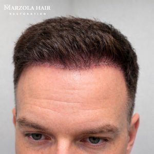 Hair-Transplant-Surgery-Offered-in-Adelaide-2