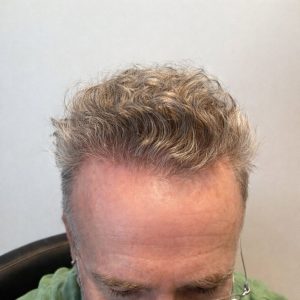 Hair Restoration Adelaide South Australia
